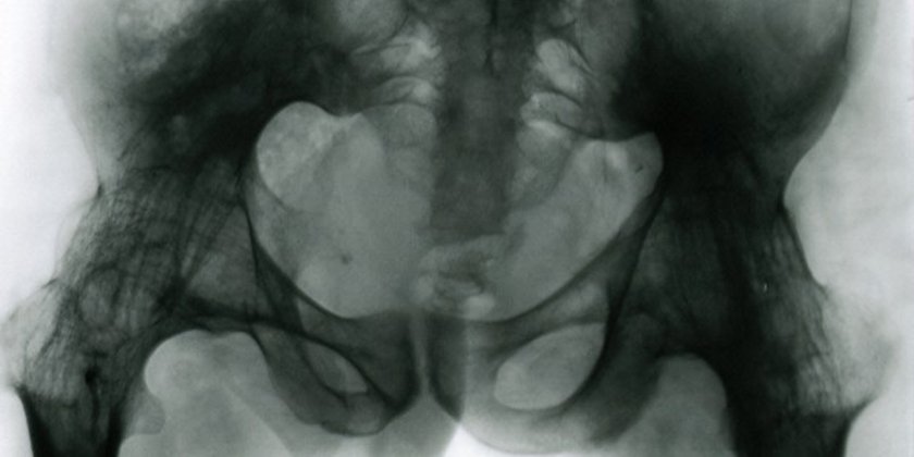 image of pelvis and femur