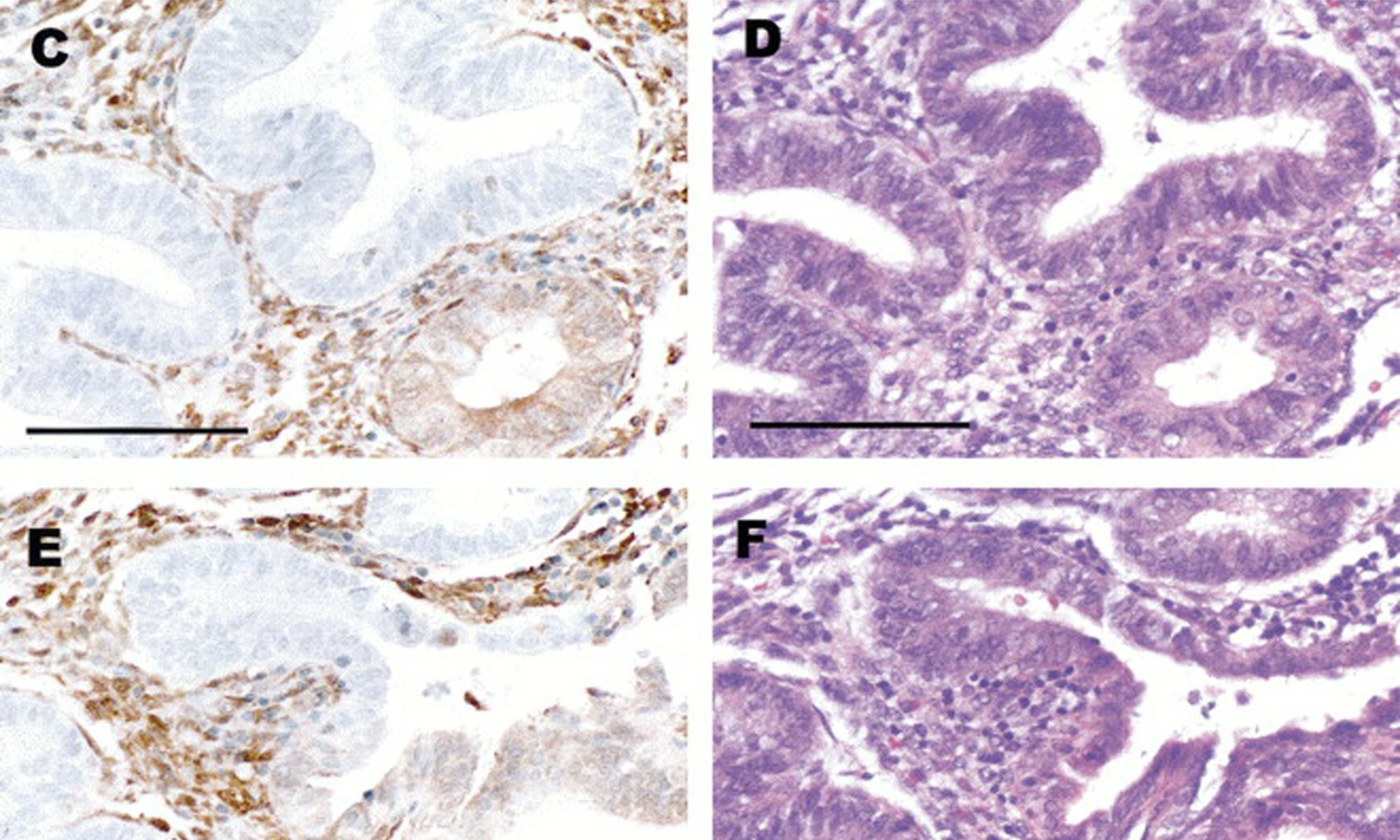 image of PTEN protein in endometrial cancer