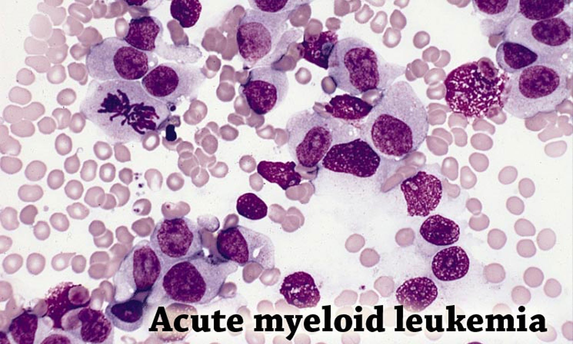 Neonatal acute myeloid leukemia in an infant whose mother was exposed to diethylstilboestrol in utero