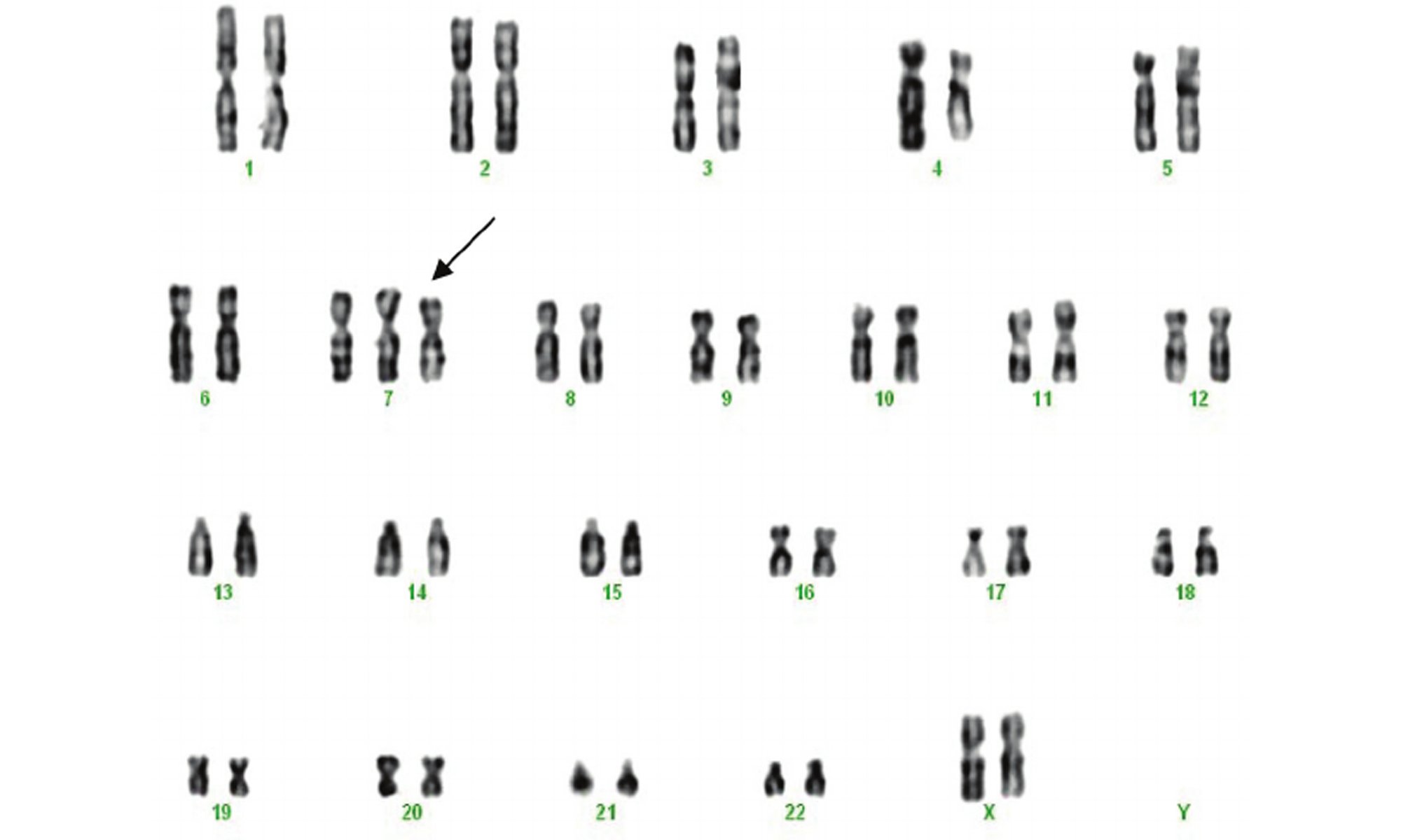 image of trysomy-7