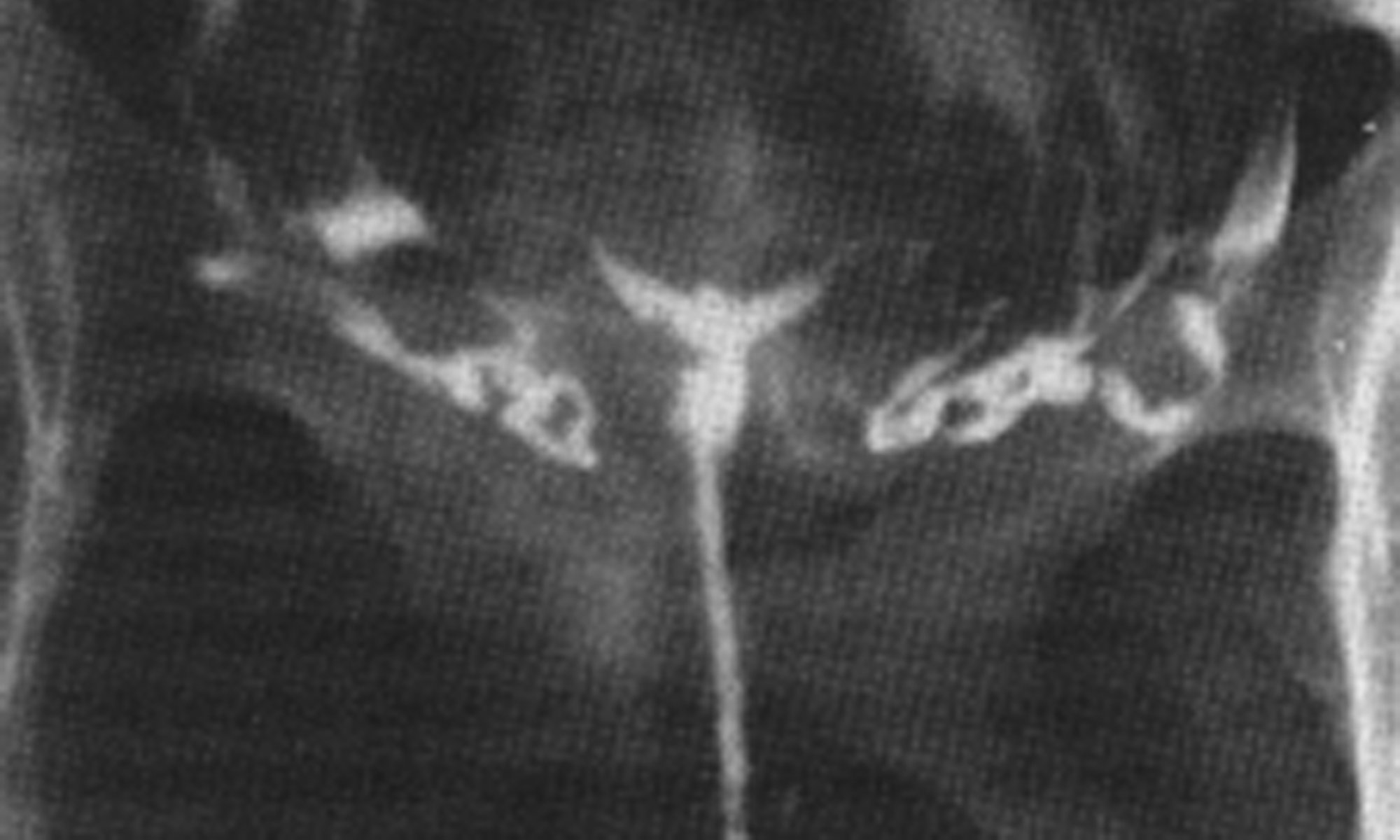 image of small T-shaped uterus