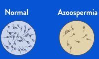 Azoospermia in DES-treated male progeny
