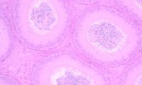 Prenatal DES and lesions of testis and epididymis